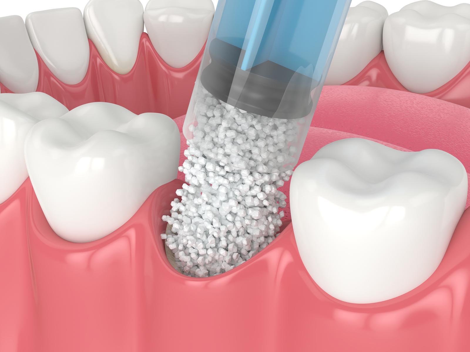 Dental Bone Grafting